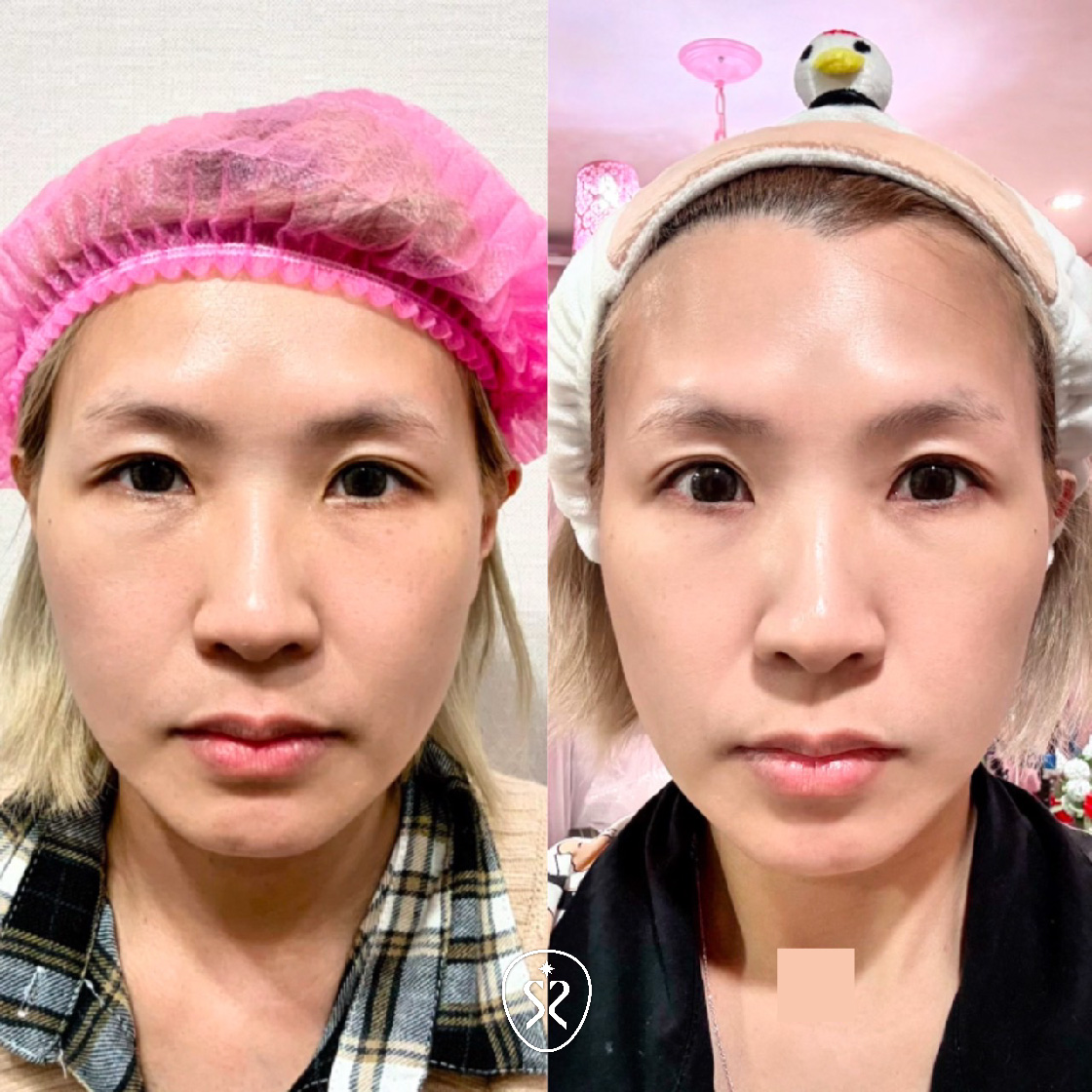 施作完玩美電波的前後對比